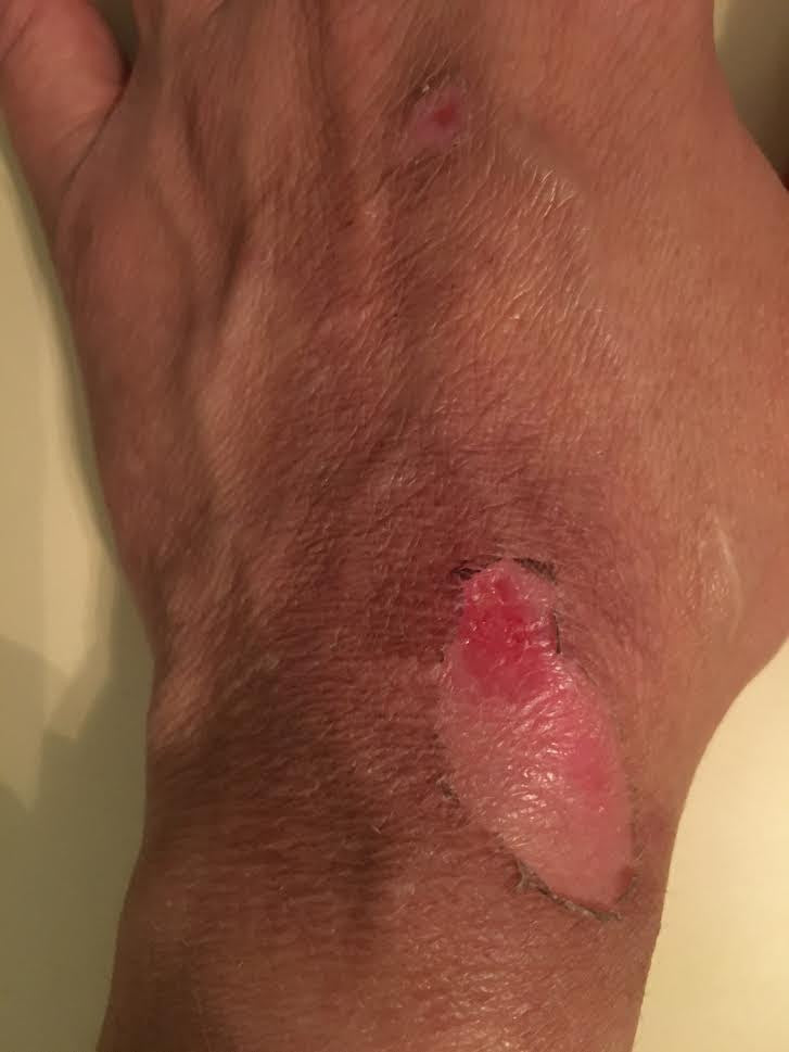 Testimonial on Burns